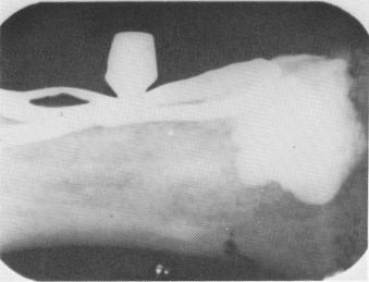 2 Rubber base material removed after subperiosteal implant impression made