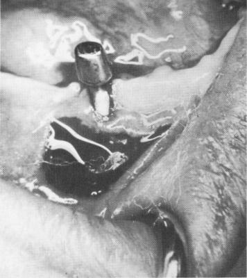 3 Horizontal incision of soft tissue around subperiosteal implant post