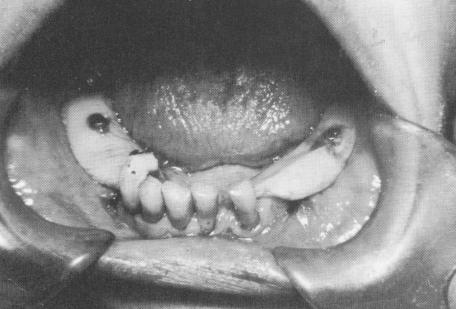 1 Bandages protect soft tissues around subperiosteal implants