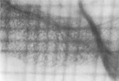 4 Grid correlates bone depth with Tramonte spiral-post implant length
