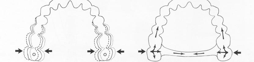 1 Palatal bar reduces torque action and helps stabilize implant template 