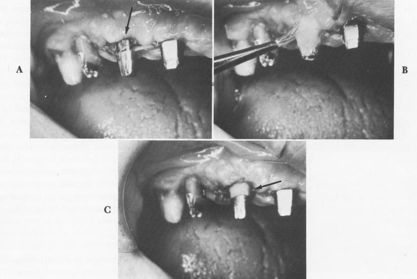 1 Layer by layer acrylic resin application on implant abutment posts