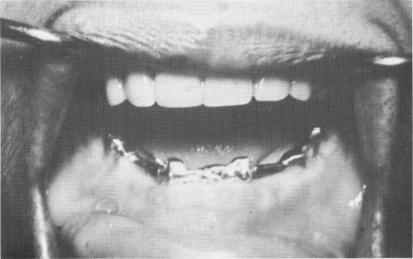 1 Soft implant copings soldered to a connecting bar