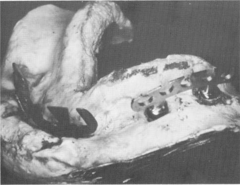 1 Duplicate endosseous blade implants set in lower plaster index