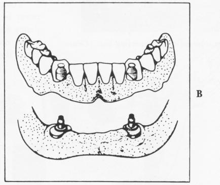 2 Solid Gerber attachment over implants