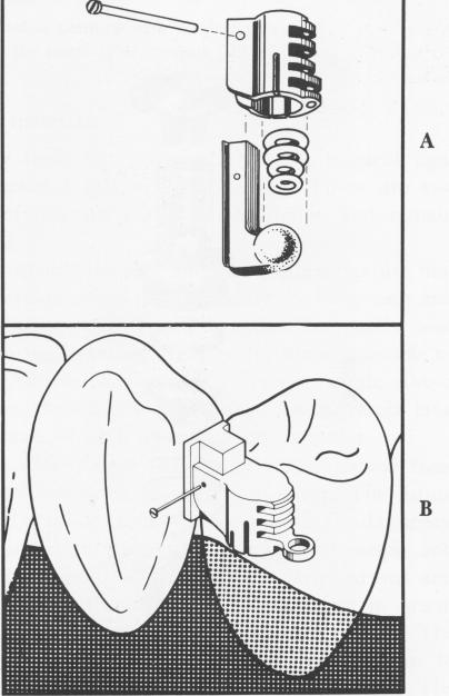2 Dalbo posterior stress breaking attachments over implant prosthesis