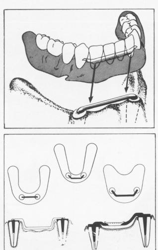 3 Suturing after implantation procedures in maxilla and mandible