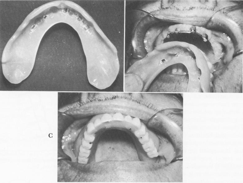 1 Palateless upper implant denture with semicircular attachments