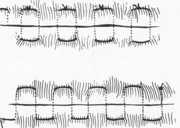 1 Continuous Lempert suture for flabby tissue near subperiosteal implant 