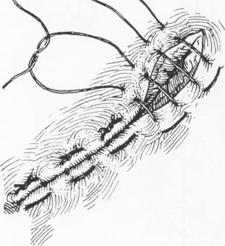 2 Mattress sutures for subperiosteal implant submucosal tissue contact