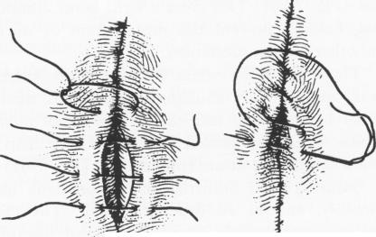 3 Halsted mattress suture, subperiosteal implant surface tissue contact