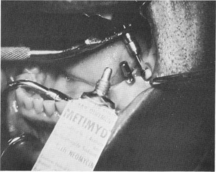 1 Spiral of post type endosseous implant with inflammatory lubricant