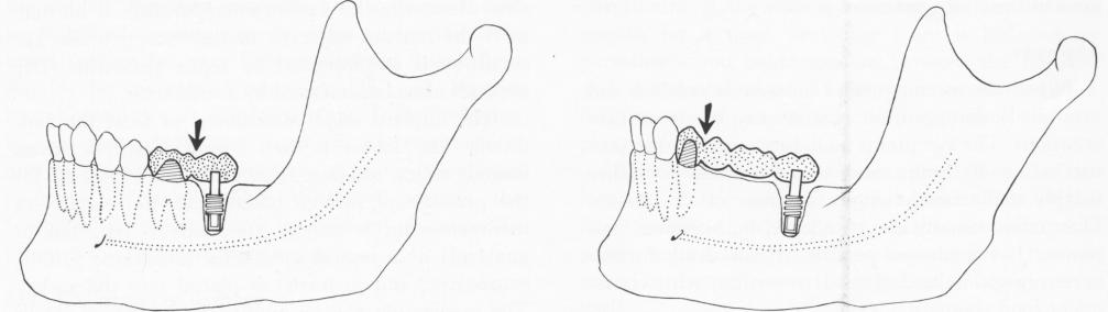 1 Crowns separated, post type implant removed, if two unit splint fails
