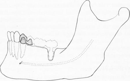 2 If reimplantation impossible,severe anterior pontic,remove restoration