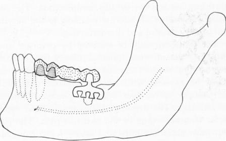 3 If blade reimplantation is possible, pontic crown prepared