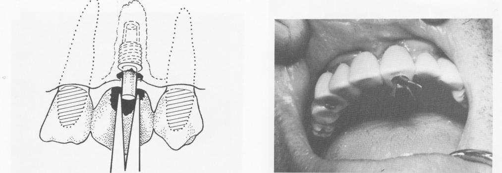 1 Saving a failing three unit endosseous implant restoration