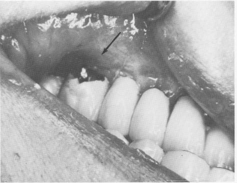 1 Buccogingival third of crown removed to remove failed posterior implant