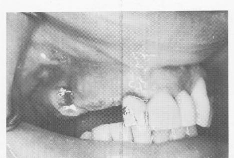 2 Crown severed from bridge, posterior triplant restoration removed