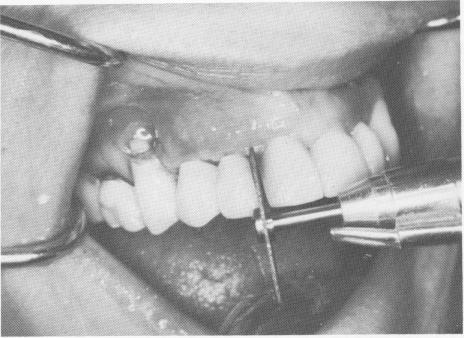 3 Restoration with triplant still attached may be slipped out easily