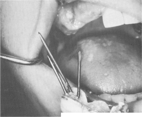 4 Vent-plant endosseous implant inserted in right cuspid region
