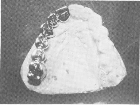 1 Endosseous implant restoration on right quadrant processed