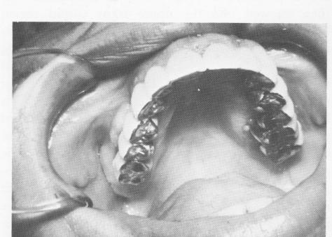 2 Pin endosseous implant drilled through posterior template