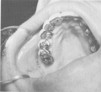 3 Upper endosseous pin implants fused with acrylic