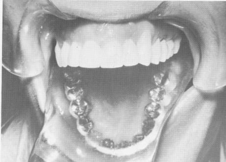 4 Molar crown cemented over upper endosseous tripod implant