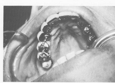 5 Emmnleterl upper and lower endosseous implant restoration