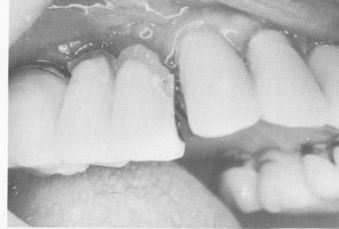 6 Upper endosseous implant bridge severed with carborundum disk