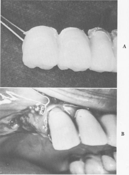 1 Endosseous upper pin implants removed along with bridge