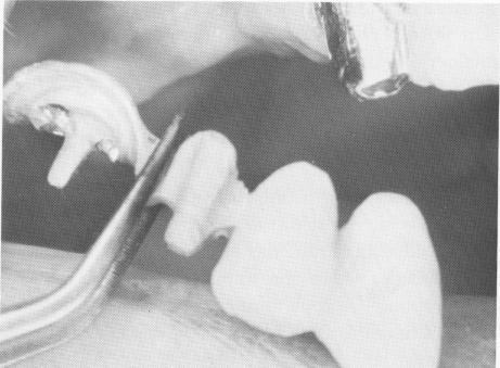 2 Upper endosseous implant prosthesis cemented over abutment tooth