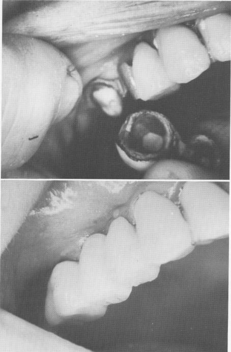 3 Endosseous implant pins through template, fused together with acrylic