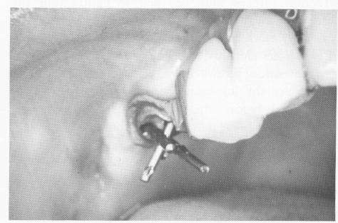 4 Upper endosseous implant superstructure cemented on core and gold post