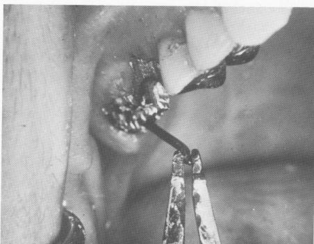 5 Individual removal of endosseous pin implant after core is disassembled