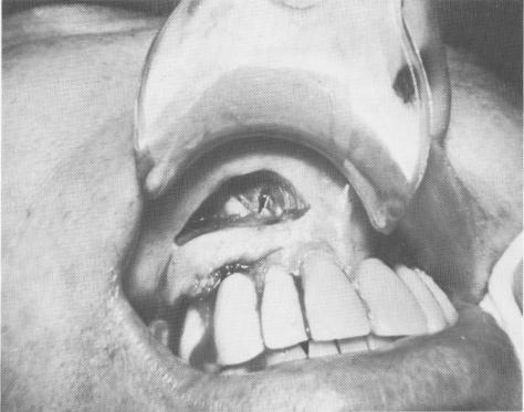 1 Expose endosseous upper tripant site, shorten pin perforating cortex 