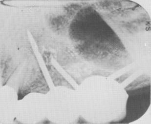 2 Radiograph of shortened upper endosseous pin implant, problem resolved