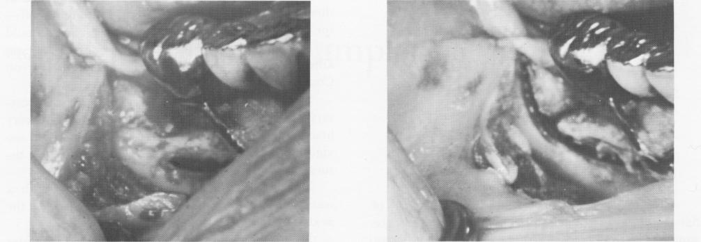 1 Entire peripheral strut of subperiosteal implant has sunk into bone