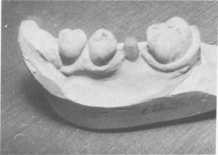 1 Stone model with duplicate implant shaft made wider than implant post