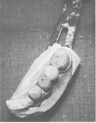 2 Acrylic crown with gold undersurface fits on enlarged implant post