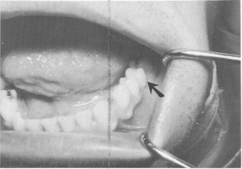 3 Acrylic restoration fit checked prior to implant insertion