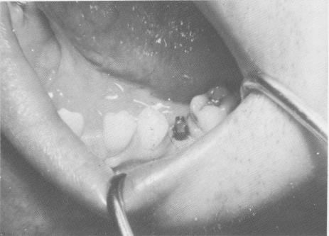 4 Vent-plant endosseous implant self-tapped into osseous structures