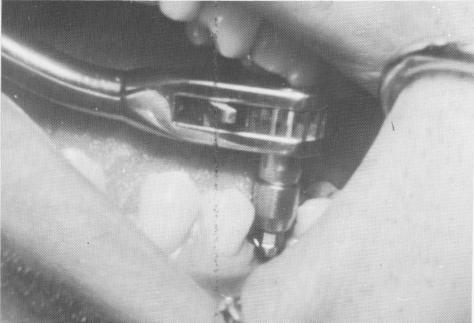 5 Implant post few mm over fibromucosal tissue, no occlusal interference