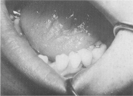 1 Acrylic & gold restoration cemented on implant shaft with hard cement