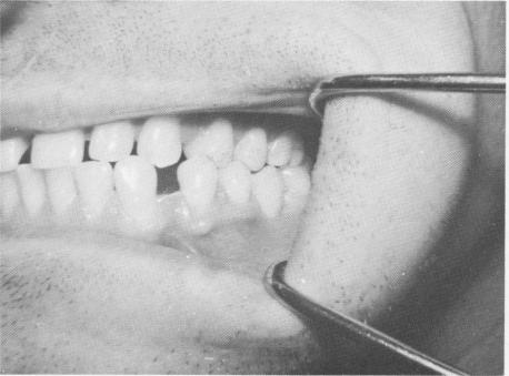 2 Carefully balanced occlusion after implant prosthesis placement