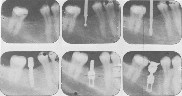 1 Radiographs showing step-by-step endosseous implantation technique