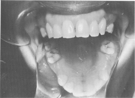 2 Bilateral missing bicuspids in caries-free maxilla, implant indication