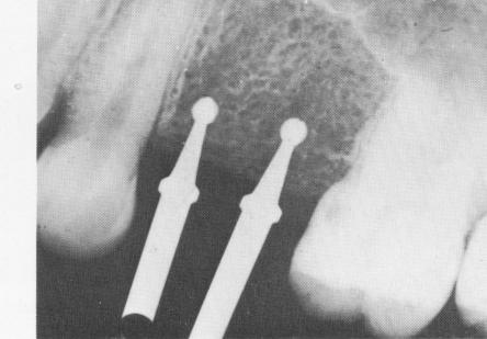 1 Radiograph showing No. 6 implant round burs drilled into bone