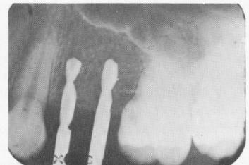 2 Self-tapping upper endosseous vent-plants implants in proper position