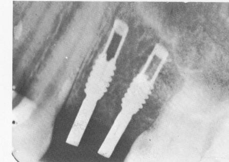 3 Endosseous implant prostheses cemented,ligature wire for stabilization